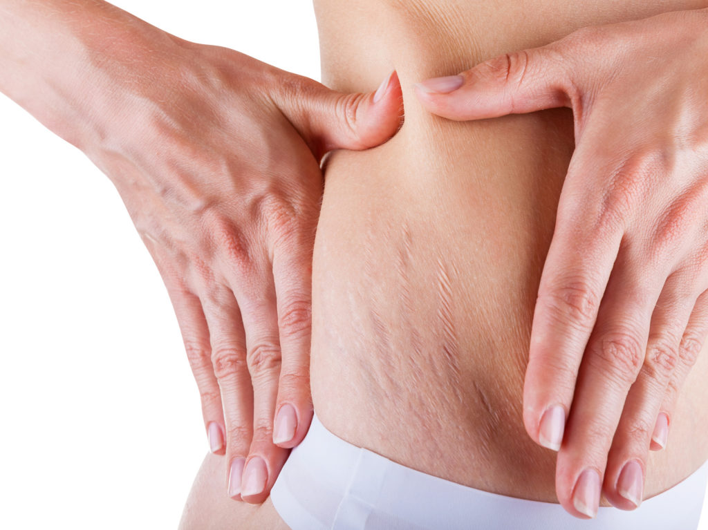Woman is testing the skin on his stomach on broadly, the presence of stretch marks