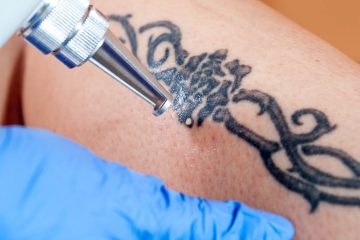 laser pikosenkundowy - zobacz jak działa i jak usuwa tatuaże!