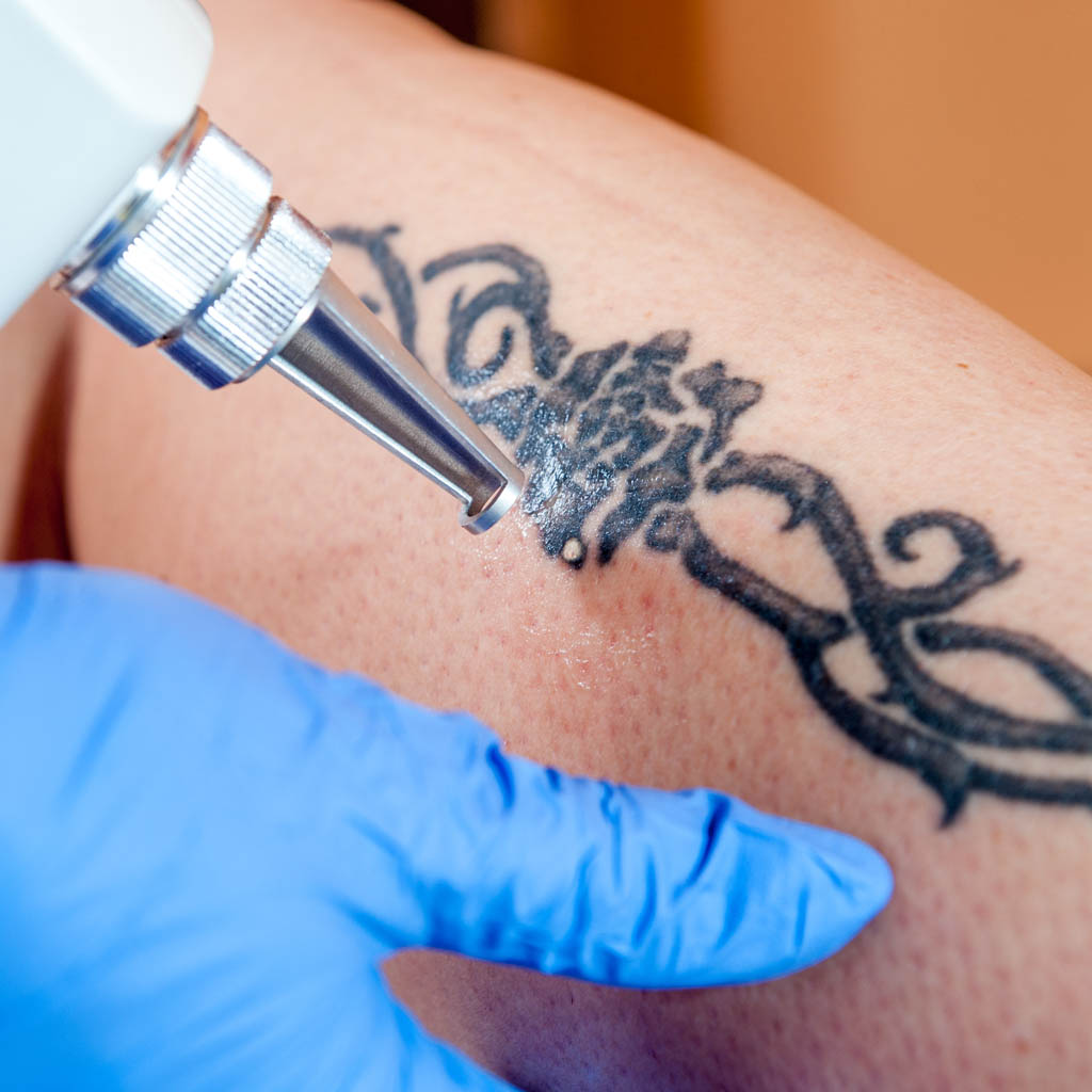 laser pikosenkundowy - zobacz jak działa i jak usuwa tatuaże!