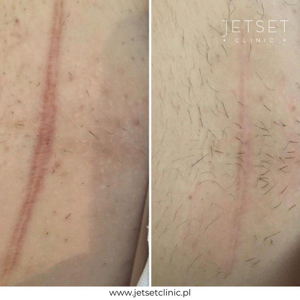 laserowa redukcja blizn - przed i po zabiegu