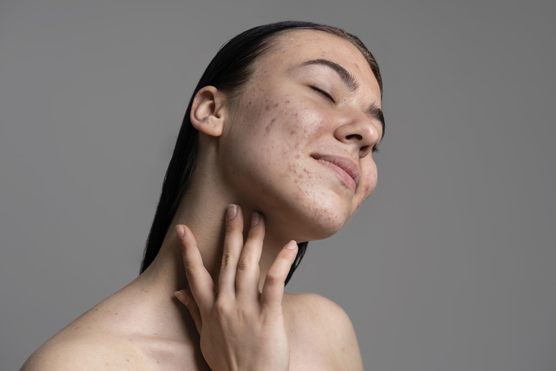 portrait beautiful young woman with acne