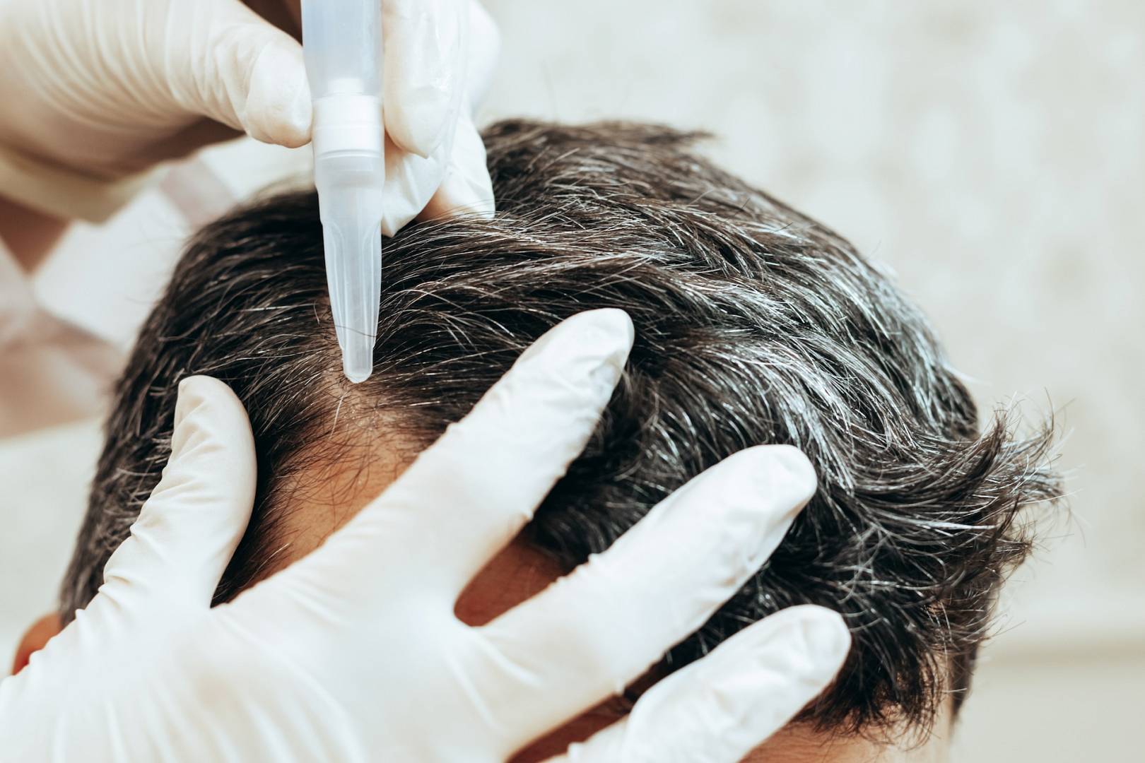 A cosmetologist performs anti aging procedures, applies hyaluronic acid serum to the scalp, for hair growth